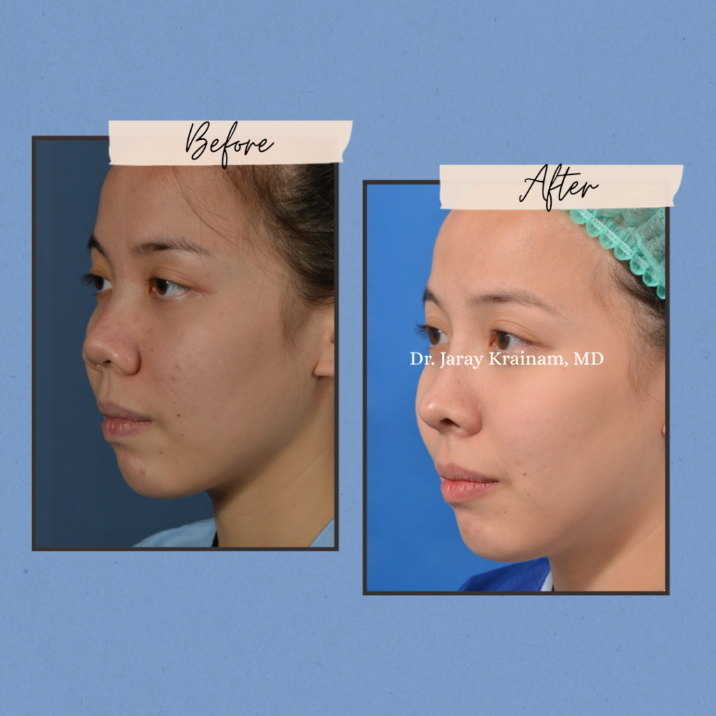 calling cards 1 - Rhinoplasty In Thailand