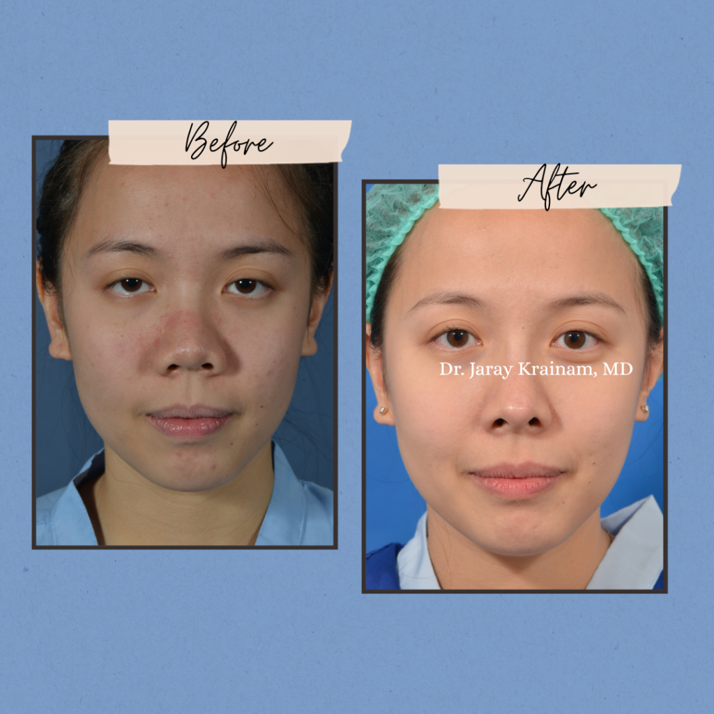 calling cards - Rhinoplasty In Thailand