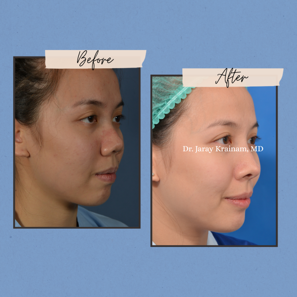 calling cards 2 - Rhinoplasty In Thailand