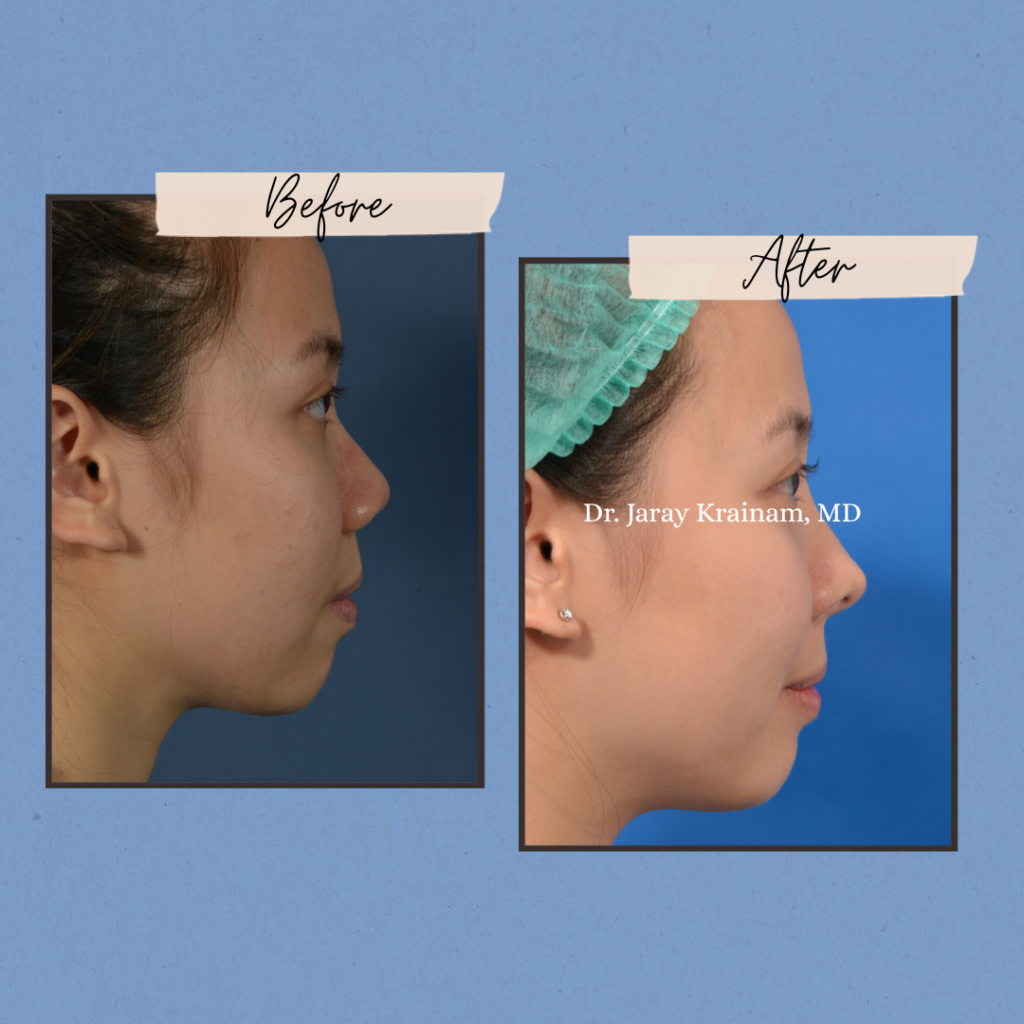 calling cards 3 - Rhinoplasty In Thailand