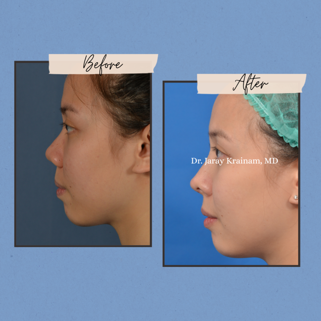 calling cards 4 - Rhinoplasty In Thailand