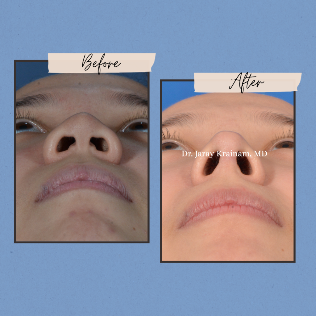 calling cards 5 - Rhinoplasty In Thailand