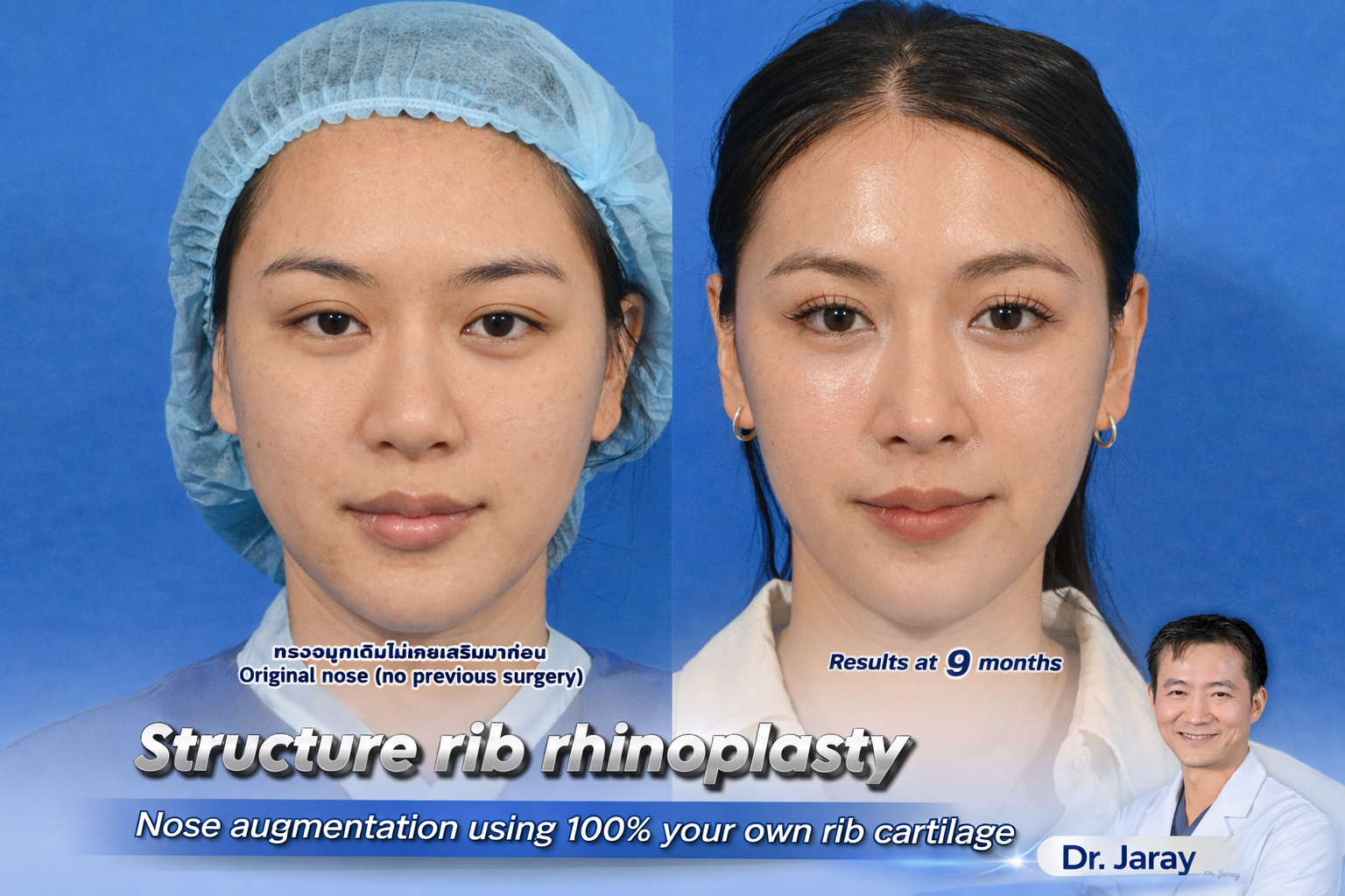 Left: woman before nose surgery; right: 9 months after rib-cartilage rhinoplasty for nose augmentation.