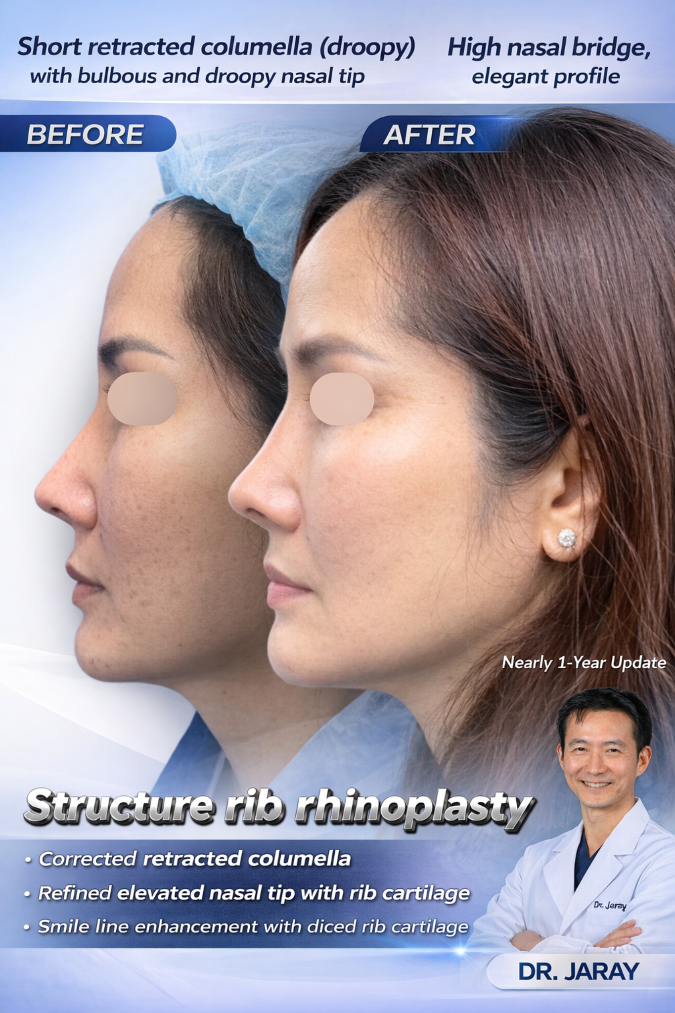 Side-by-side before-and-after profile of a woman undergoing rib cartilage rhinoplasty, showing corrected nasal tip and columella.
