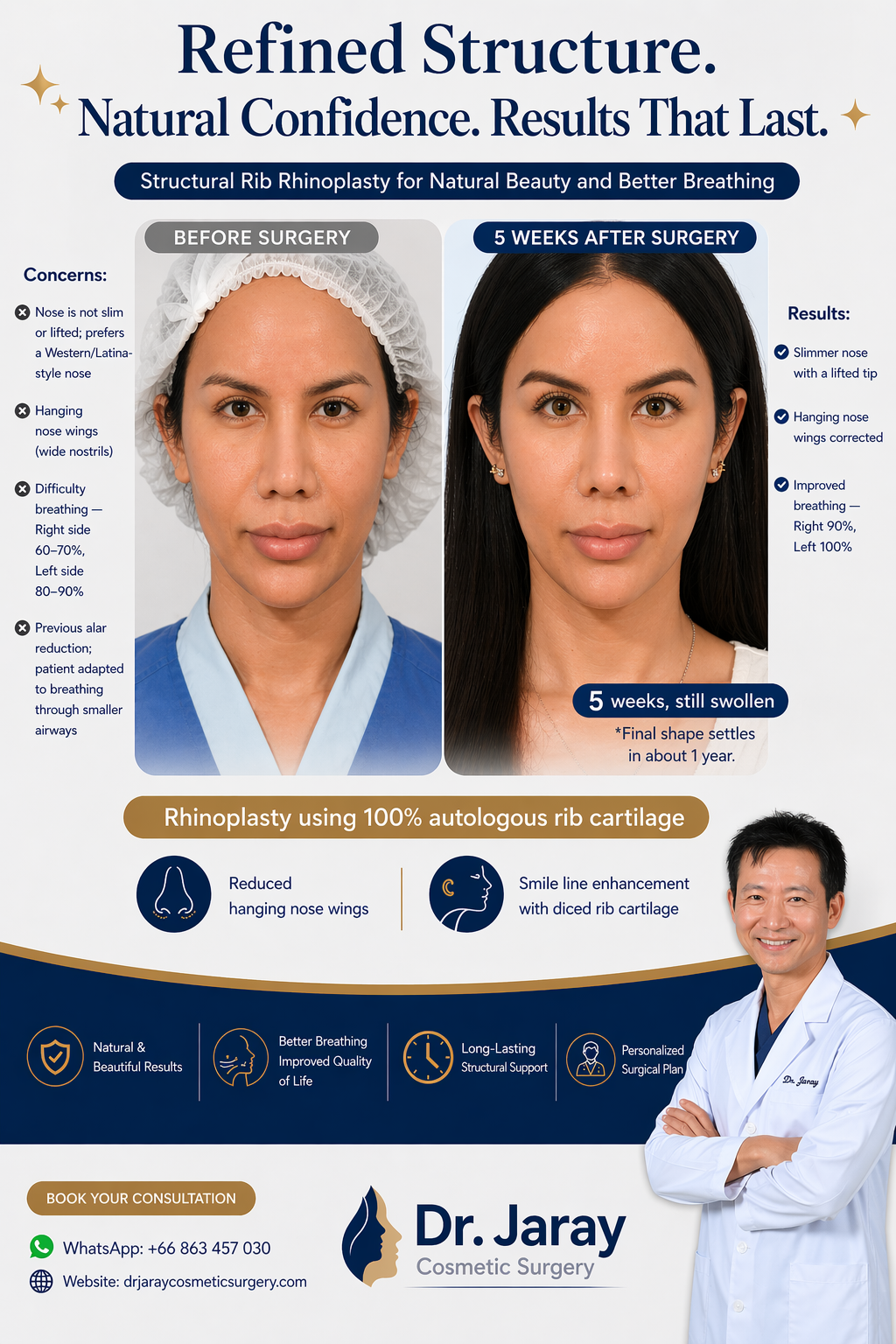 Before-and-after rhinoplasty comparison: left shows pre-surgery nose, right shows refined nose 5 weeks after rib cartilage procedure.