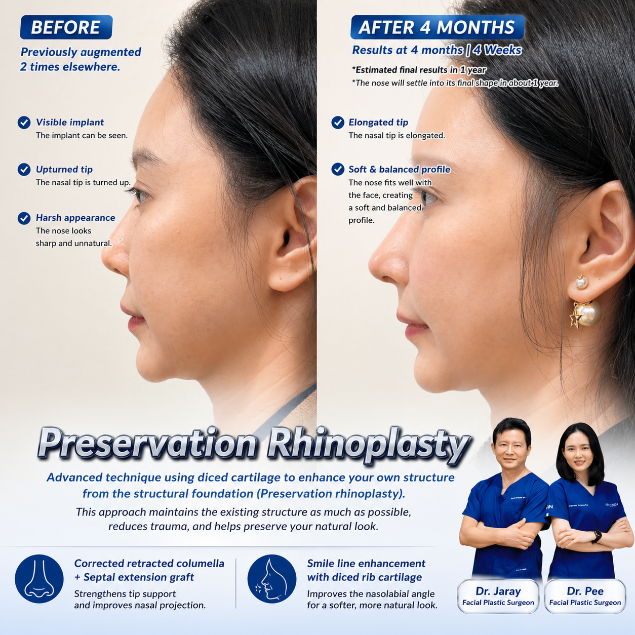 Preservation Rhinoplasty in Thailand: Natural Structure, Lasting Beauty