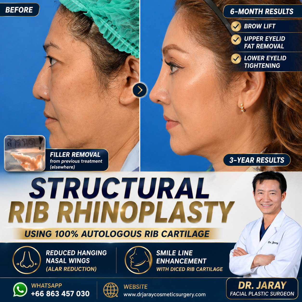 Structural Rib Rhinoplasty in Thailand: Redefining Natural, Long-Lasting Results