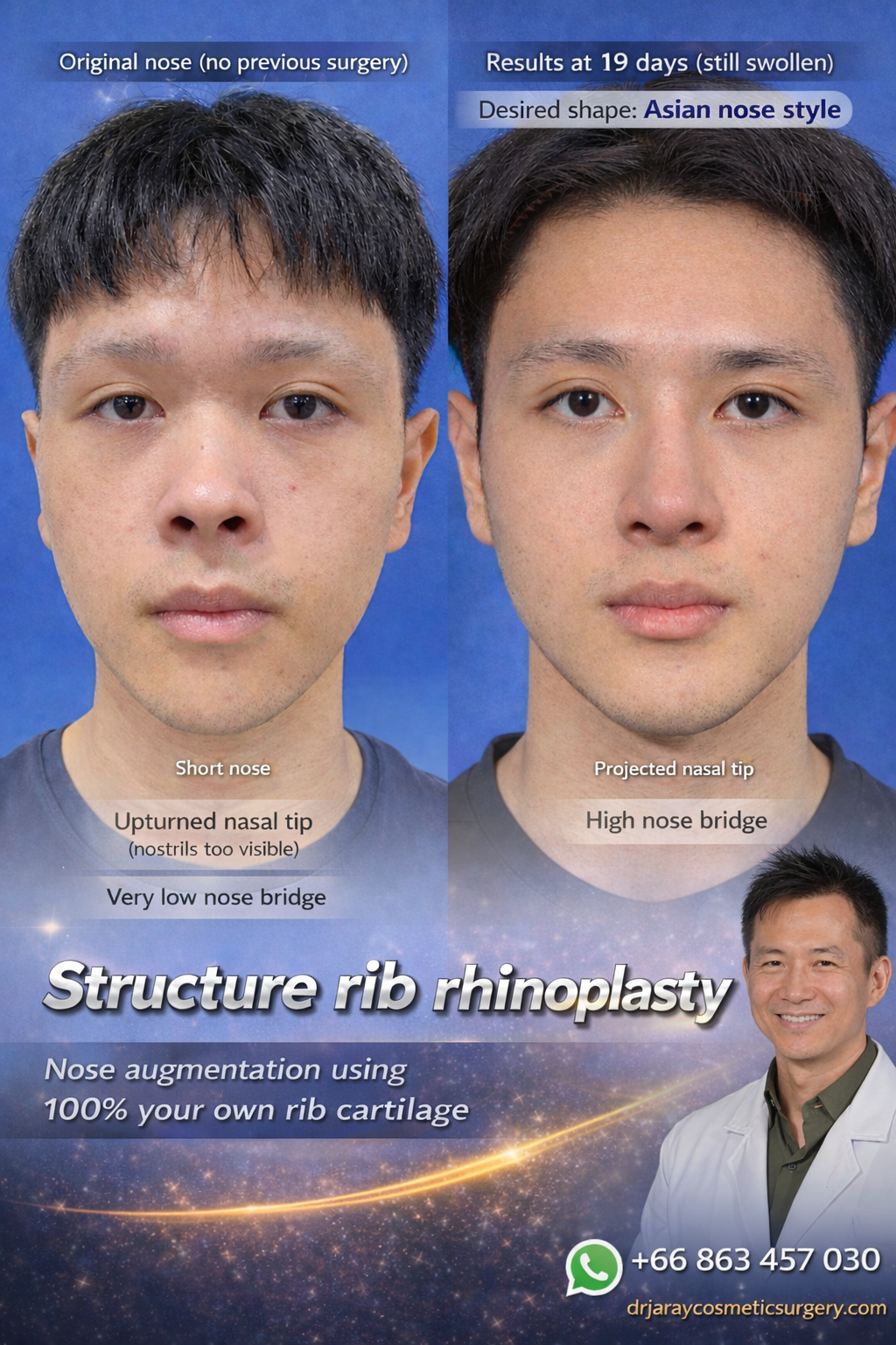 Structural Rib Rhinoplasty in Bangkok — Precision, Balance, and Natural Results