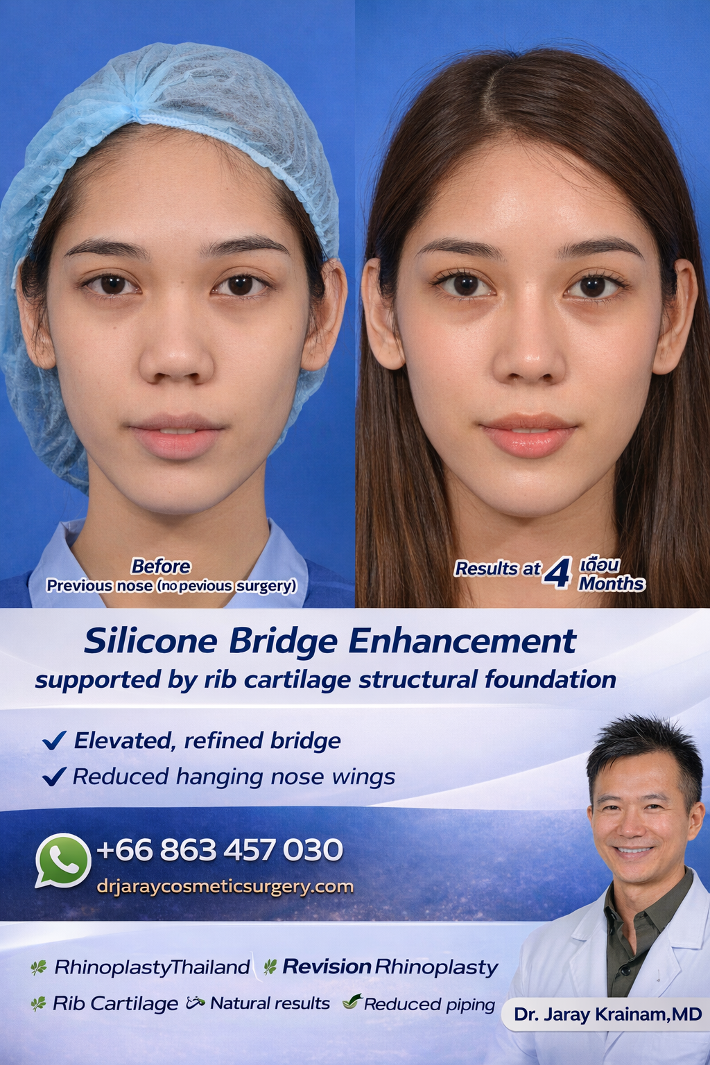 Natural Nose Enhancement with Structural Support – 4 Months Result