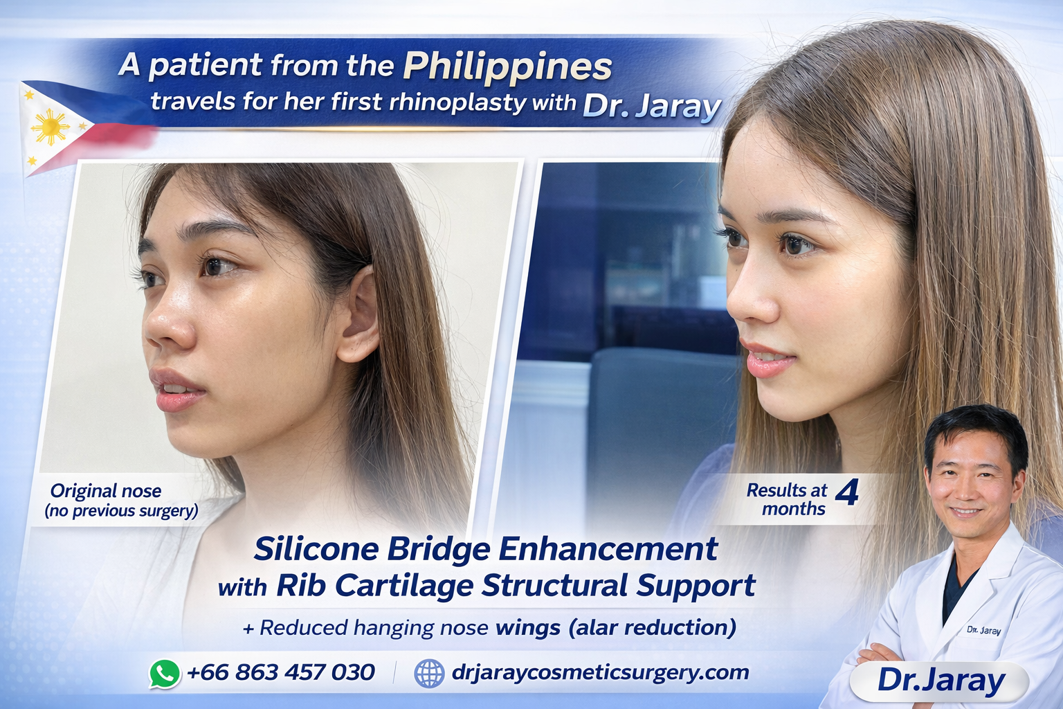 Natural Nose Enhancement with Structural Precision – 4 Months Result