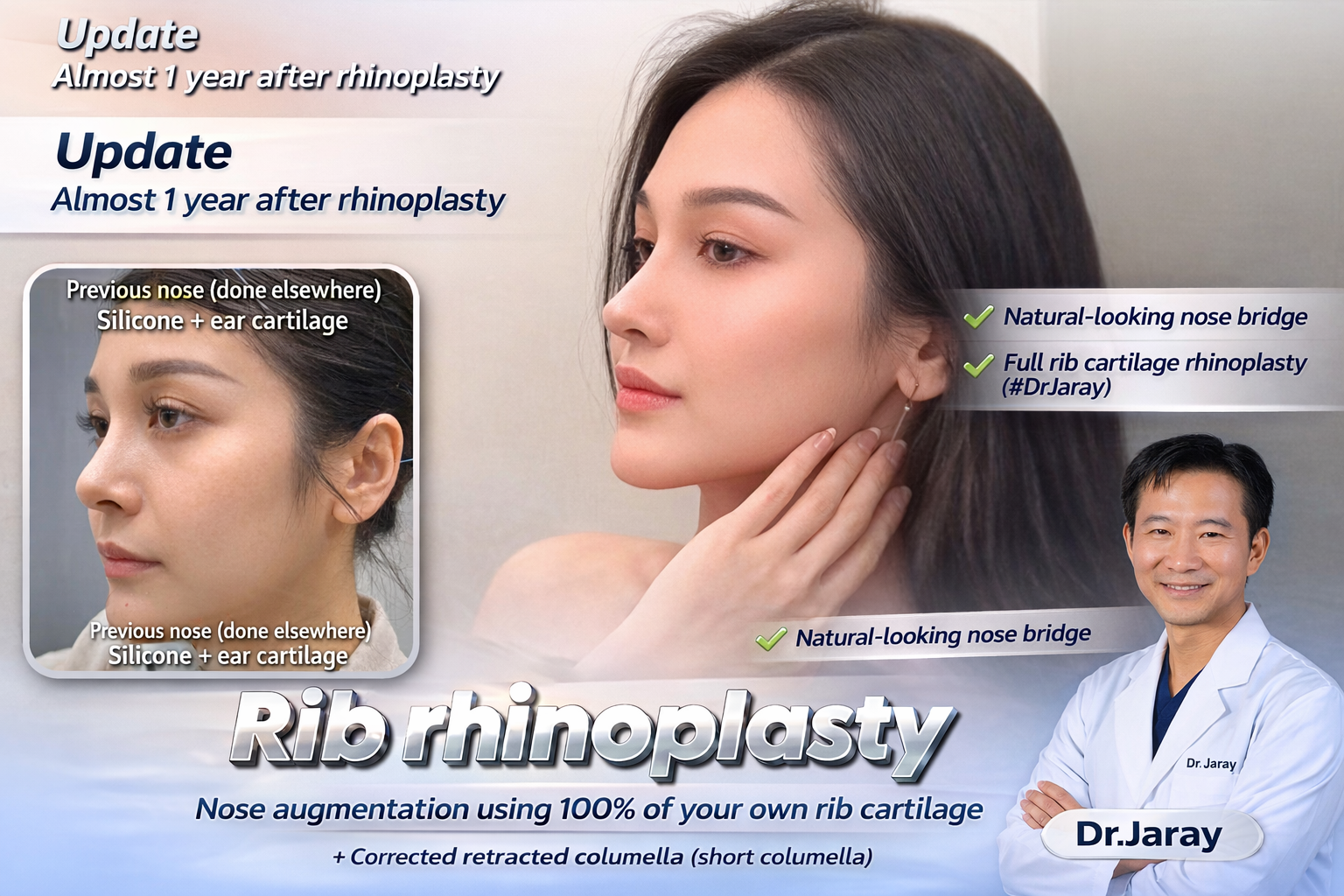 1-Year Result: Refined, Natural Rib Rhinoplasty