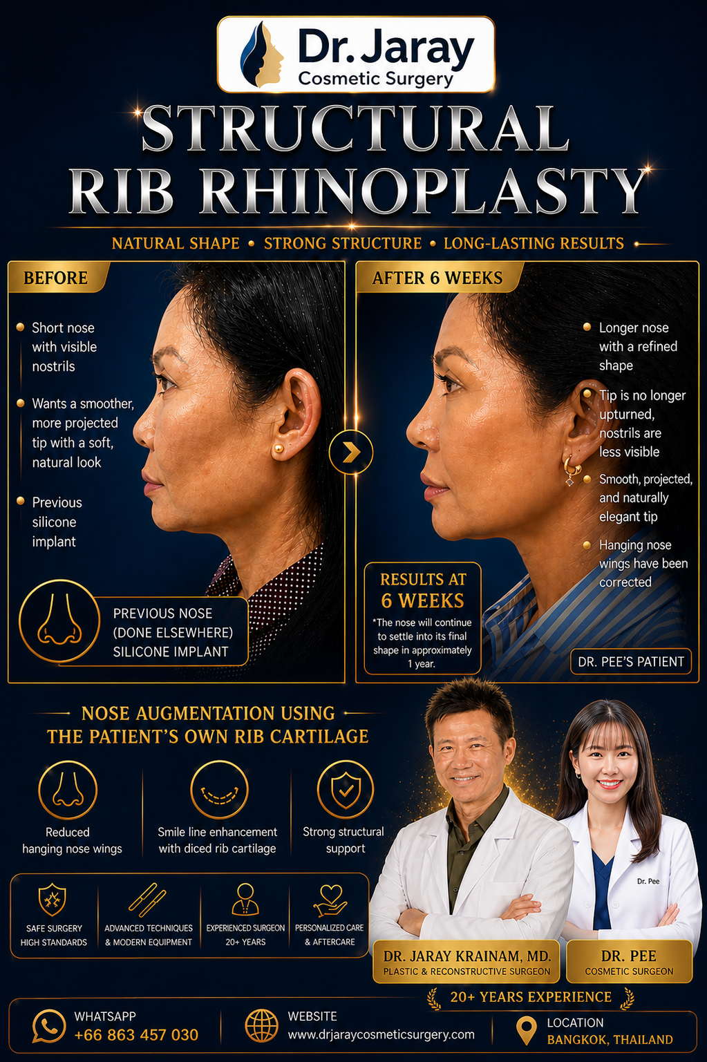 STRUCTURAL RIB RHINOPLASTY – NATURAL FORM, STRONG FOUNDATION, LASTING CONFIDENCE ✨