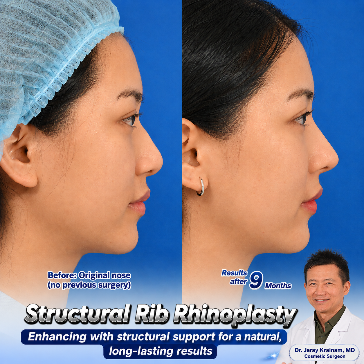 Structural Rib Rhinoplasty in Thailand with Dr. Jaray Krainam, MD
