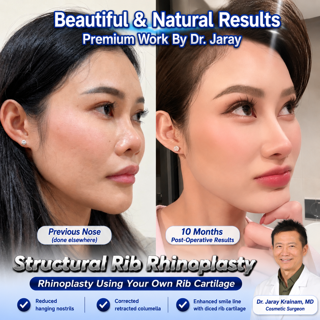 Premium Structural Rib Rhinoplasty in Thailand by Dr. Jaray Krainam, MD