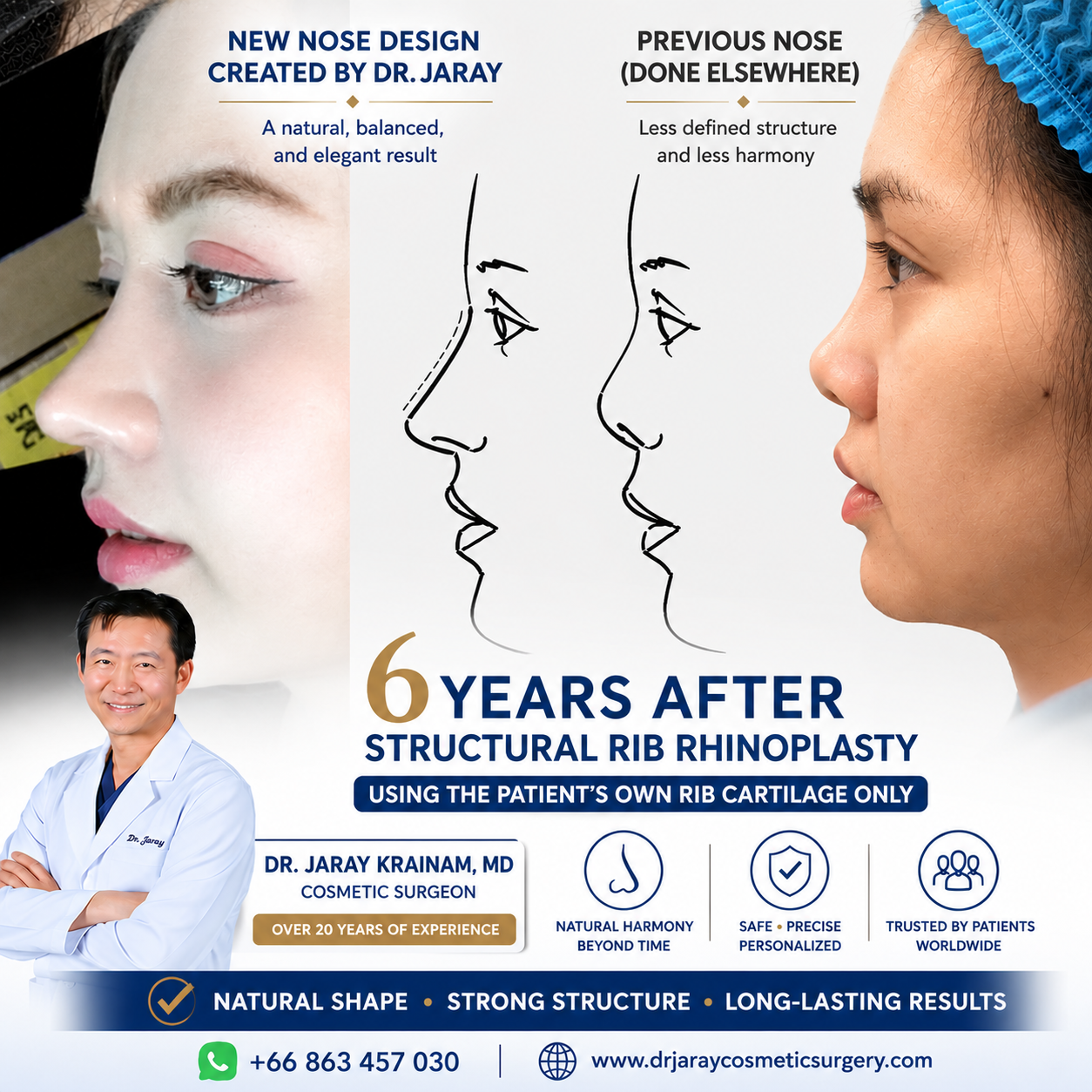 6 Years After Structural Rib Rhinoplasty — Long-Lasting Natural Harmony by Dr. Jaray Krainam, MD