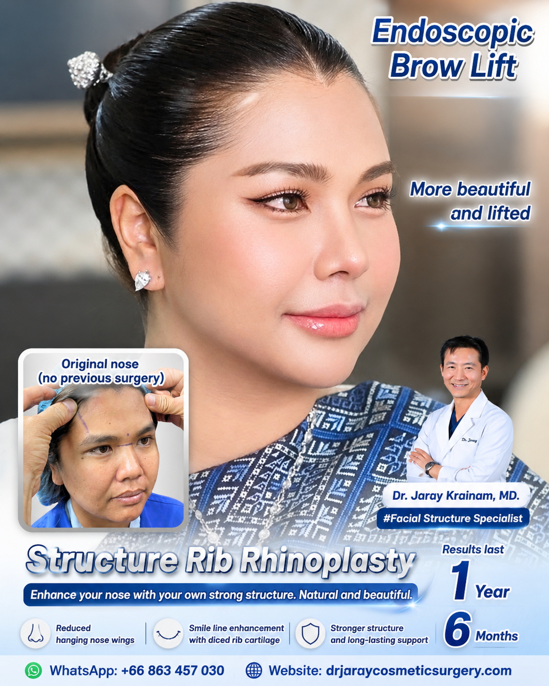 Structural Rib Rhinoplasty & Endoscopic Brow Lift